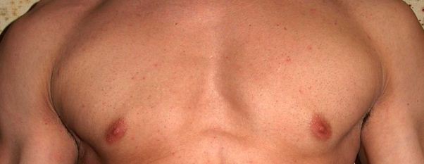 Breast Cancer Awareness: Sparing a Little Media for Men