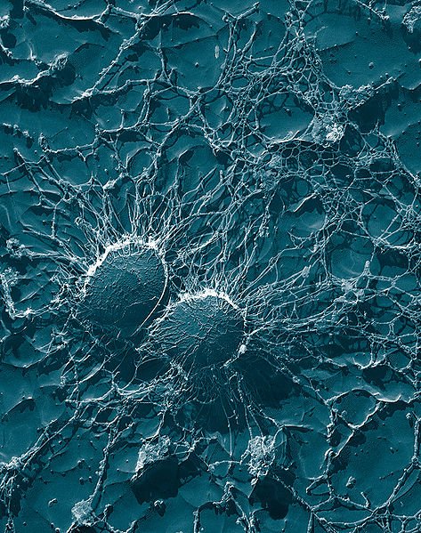 Carnival Cruise Lines PR Victim of Flesh Eating Bacteria